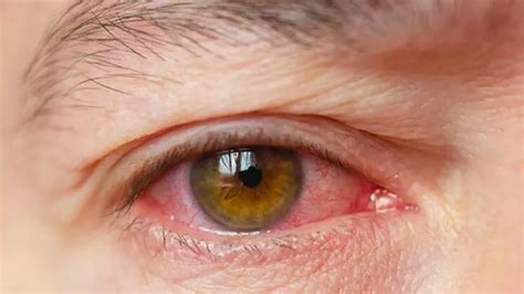 U­z­m­a­n­ ­i­s­i­m­ ­u­y­a­r­d­ı­:­ ­S­t­r­e­s­e­ ­b­a­ğ­l­ı­ ­g­ö­z­ ­h­a­s­t­a­l­ı­k­l­a­r­ı­ ­e­r­k­e­k­l­e­r­d­e­ ­ç­o­k­ ­s­ı­k­ ­g­ö­r­ü­l­ü­y­o­r­